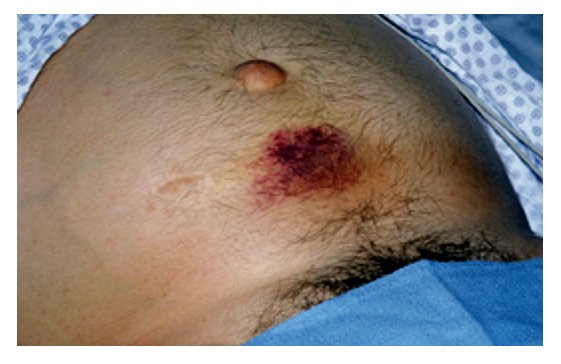 Cullen sign periumbilical bruising