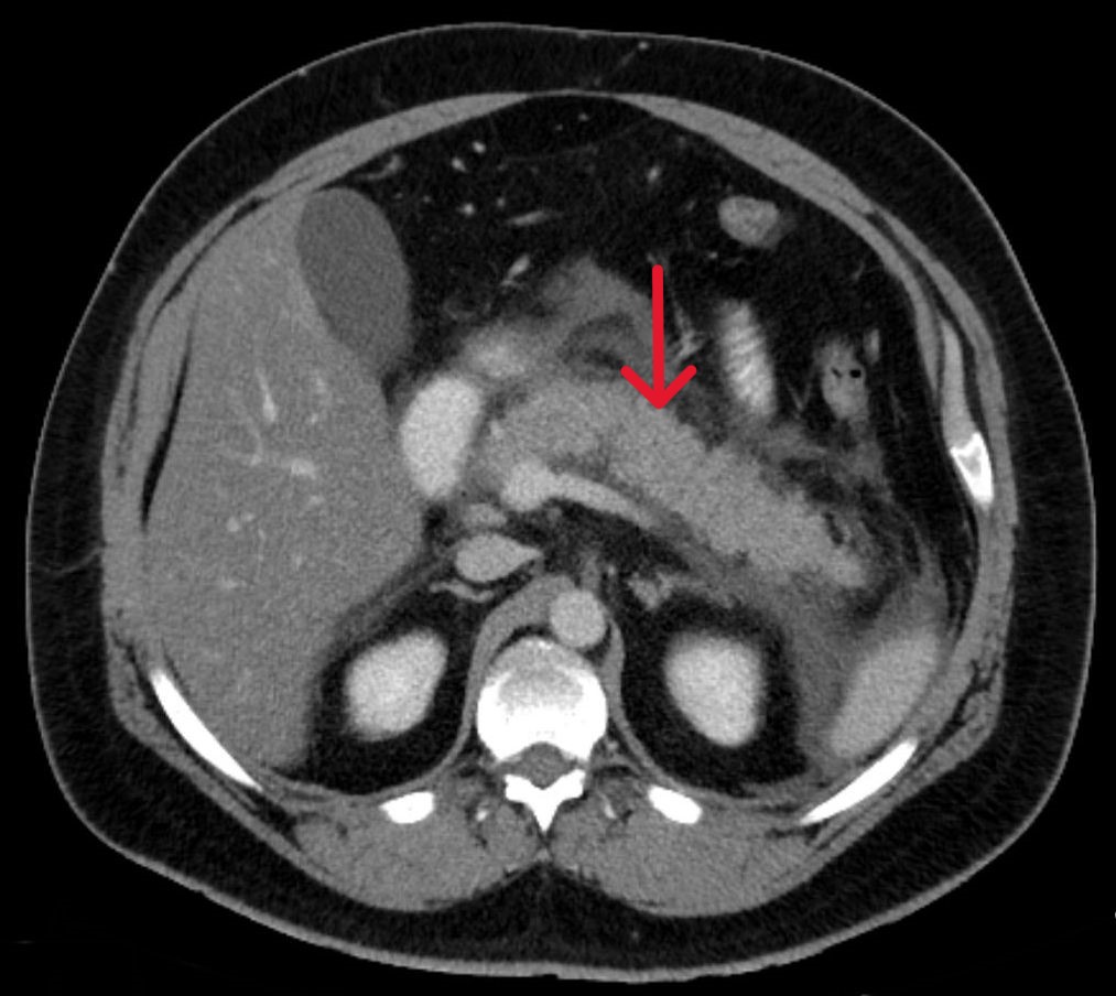 CT scan acute pancreatitis