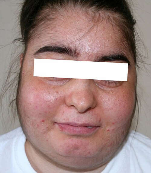 Clinical features of Cushing syndrome showing central obesity and moon face
