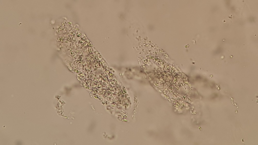 Muddy brown granular casts on urinalysis microscopy