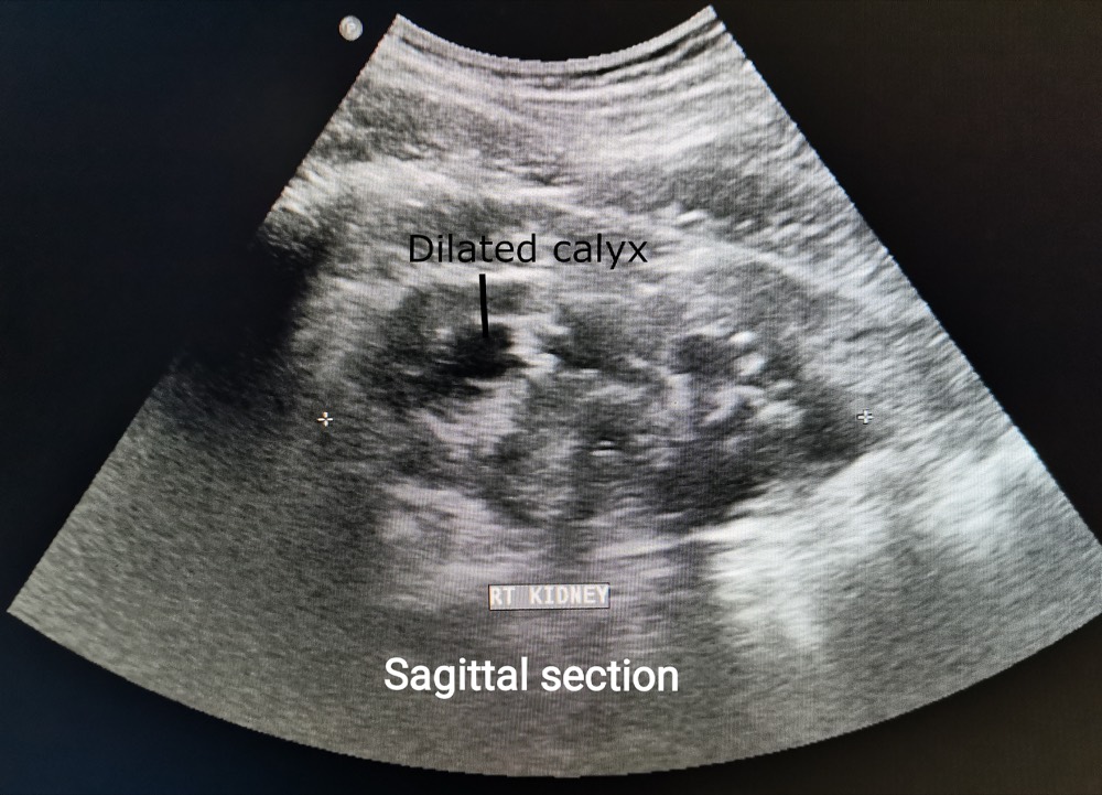Renal ultrasound showing moderate hydronephrosis