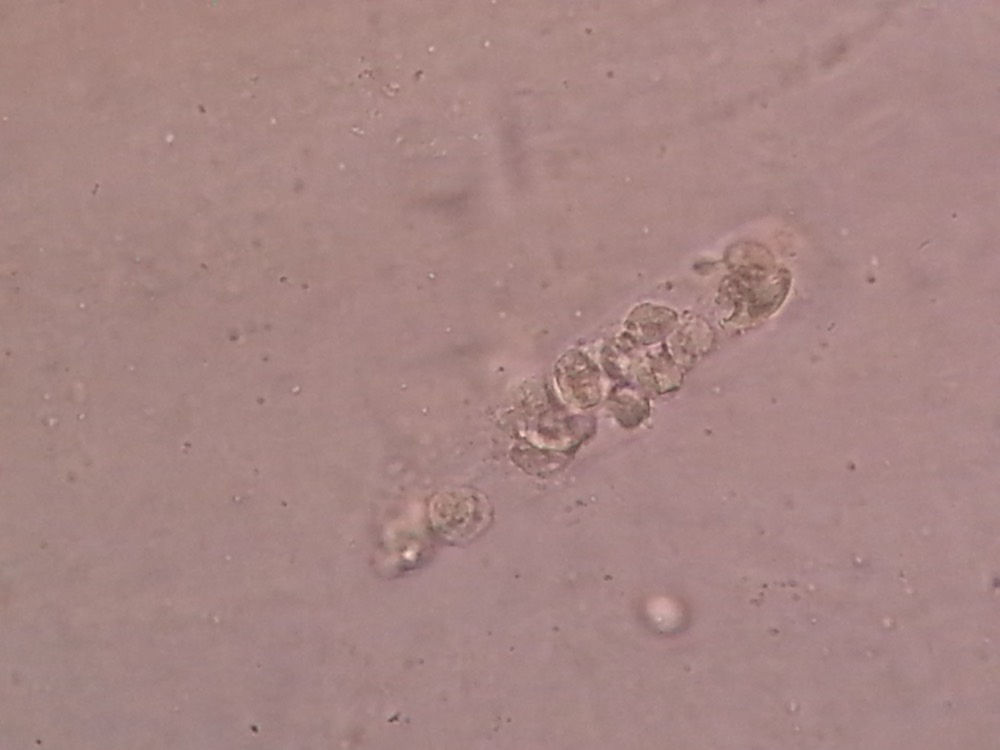 White blood cell cast in urine microscopy