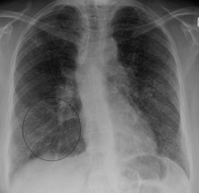 AP chest X-ray showing bilateral hilar lymphadenopathy in sarcoidosis