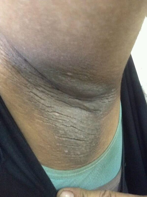 Acanthosis nigricans on neck