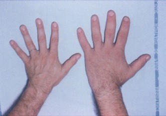 Enlarged hands in acromegaly