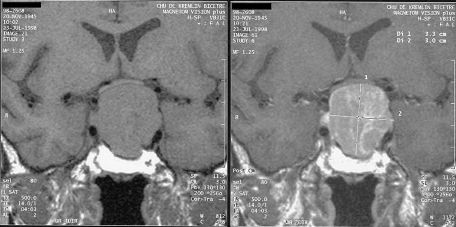 Pituitary macroadenoma on MRI