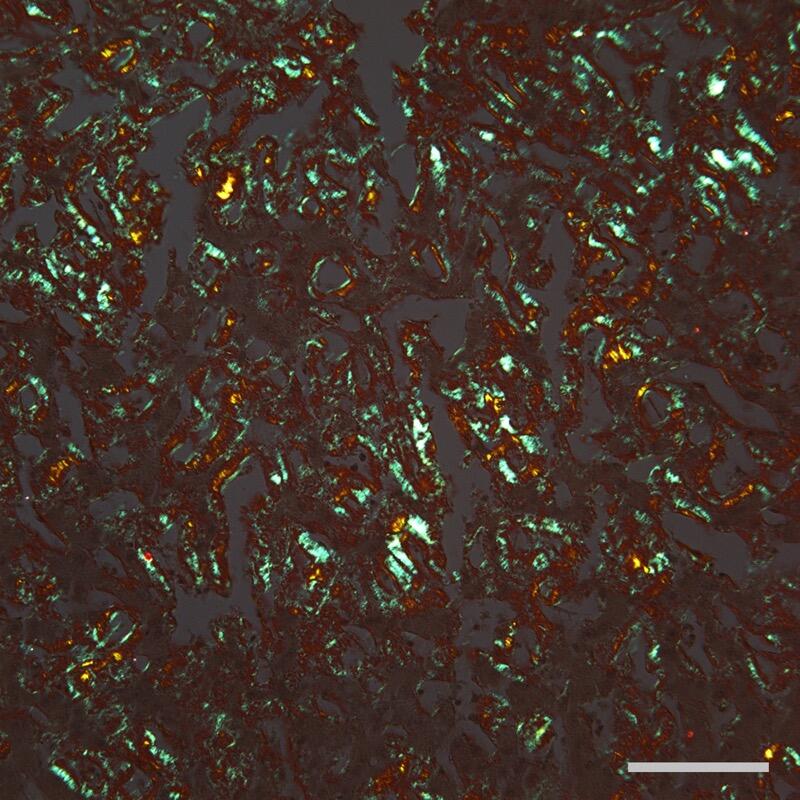 Congo red stain showing amyloid deposits