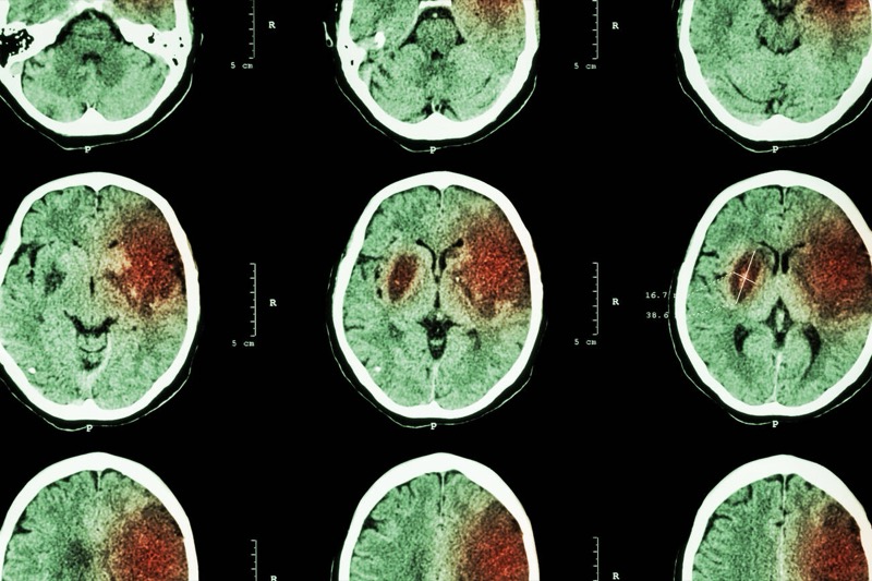 Brain CT scan showing stroke