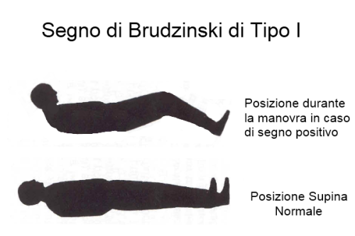 Brudzinski sign demonstration