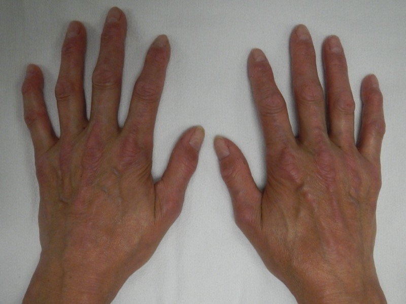 CREST syndrome skin findings