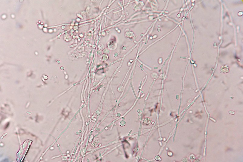 Candida albicans with pseudohyphae
