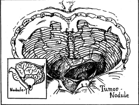 Cerebellar hemangioblastoma of Von Hippel-Lindau disease