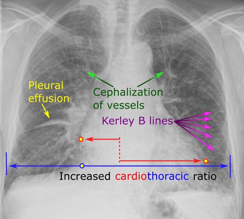 Chest X-ray showing congestive heart failure