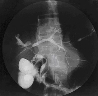 ERCP cholangiogram showing primary sclerosing cholangitis