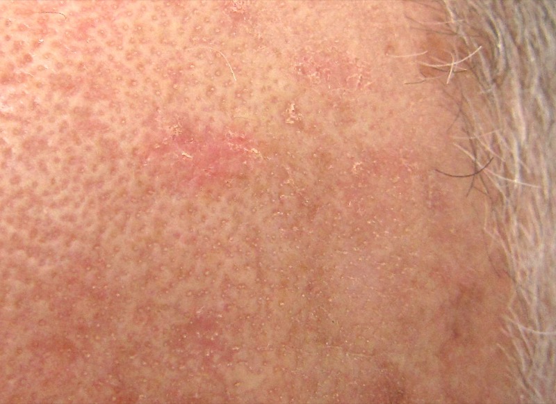 Close view of actinic keratosis showing rough scaly texture