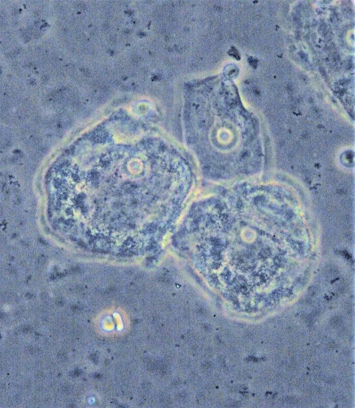 Clue cells in bacterial vaginosis