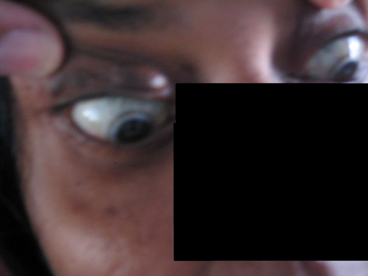 Corneal arcus in a young patient