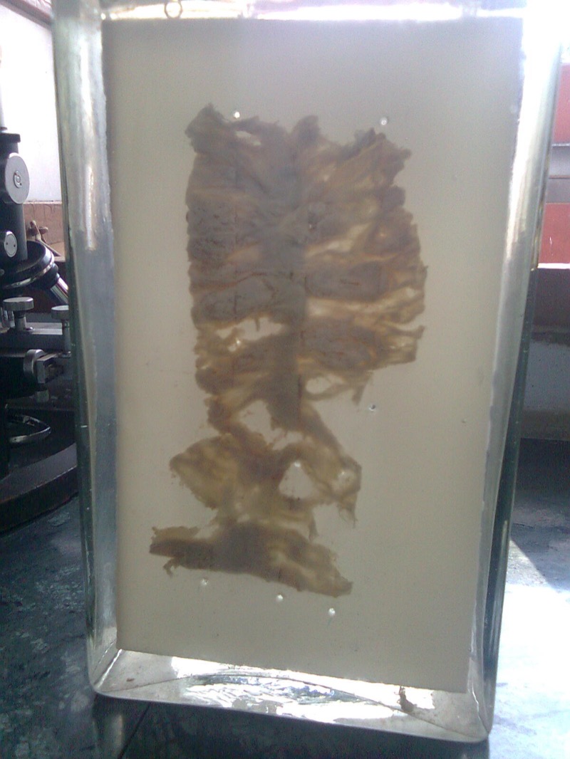 Crohn disease gross pathology of colon