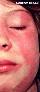 Dermatomyositis skin findings