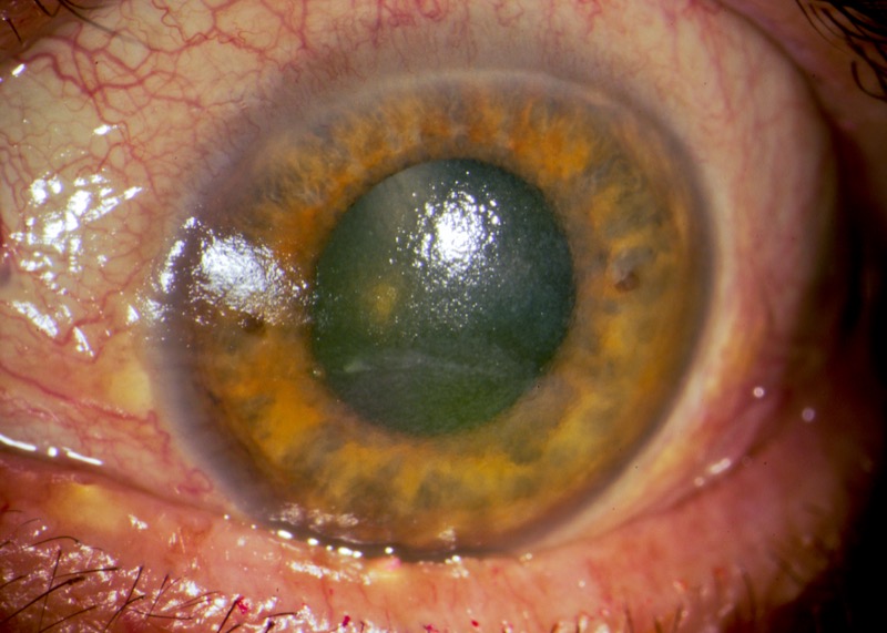 Dry eye keratoconjunctivitis sicca