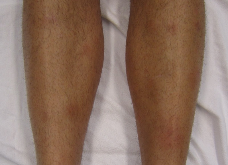Erythema nodosum → tender red nodules on the shins