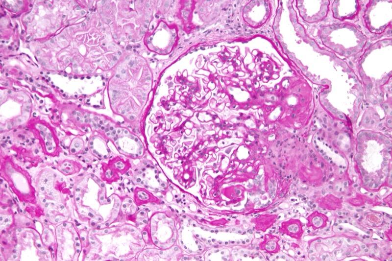 FSGS hilar variant on light microscopy