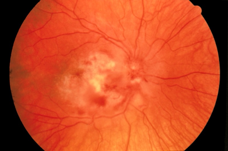 Fundus photograph of CMV retinitis with retinal whitening and hemorrhage