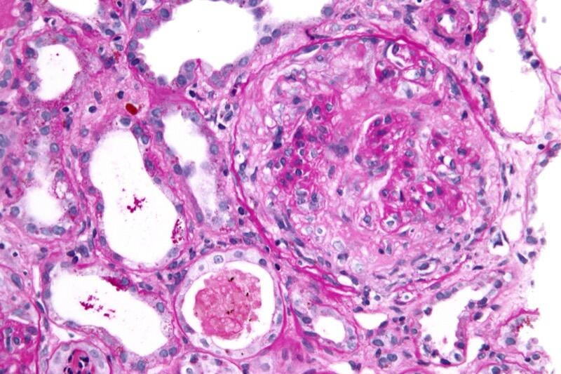 Crescentic glomerulonephritis showing crescents in Bowman's space