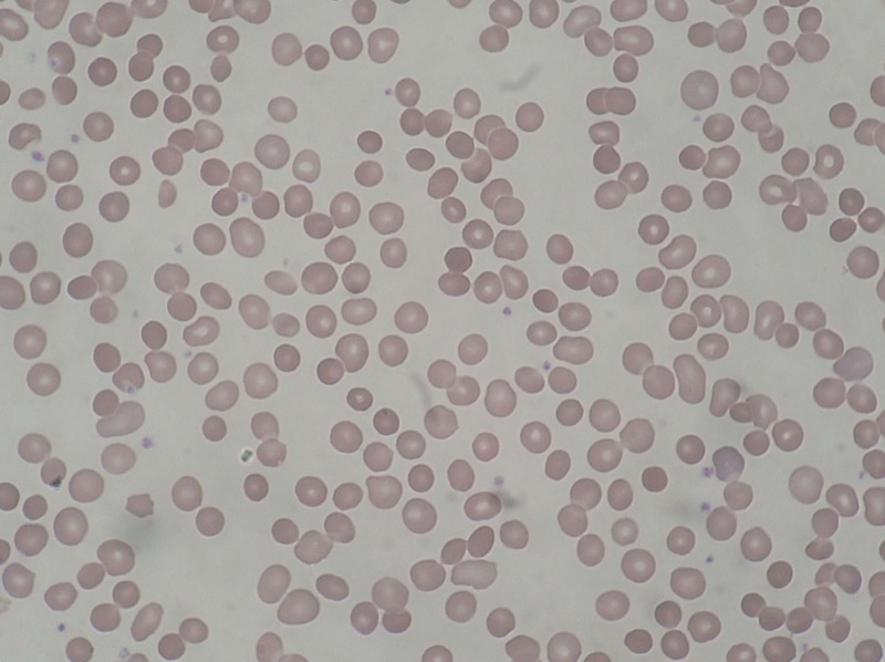 Spherocytes on peripheral blood smear