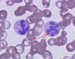 Hypersegmented neutrophil