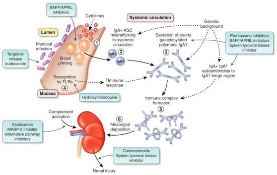 IgA nephropathy histology