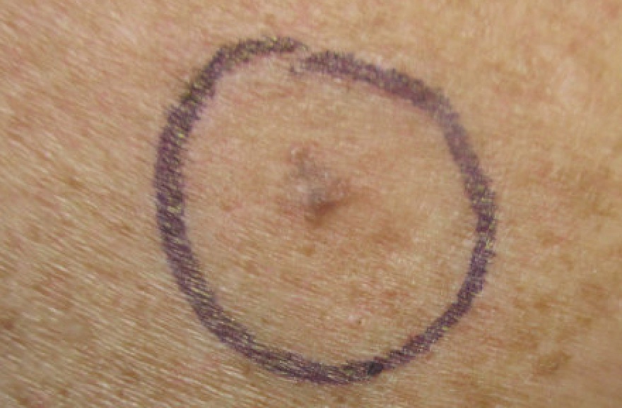 Malignant melanoma on posterior shoulder