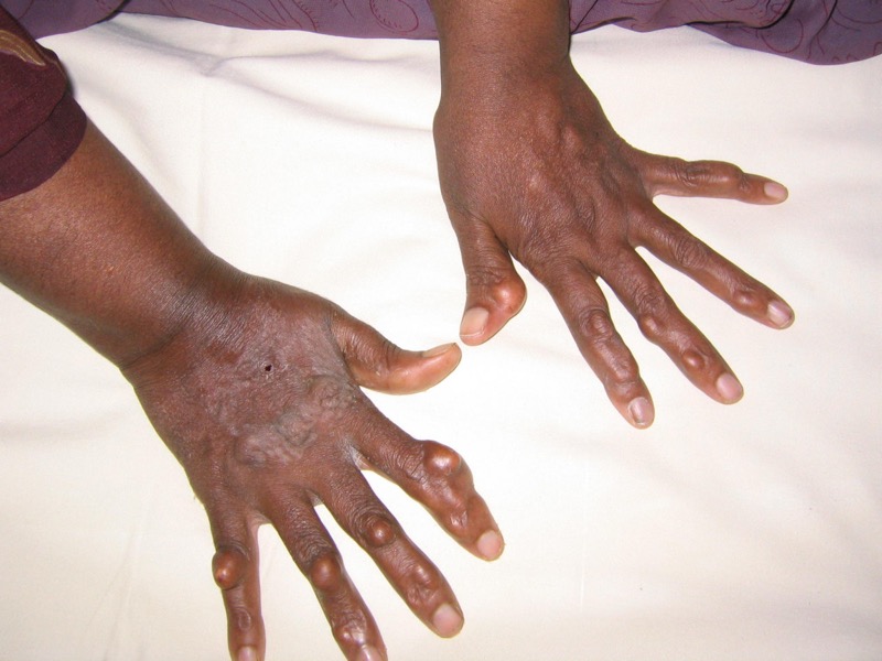 Multiple tendinous xanthomas on the hands in familial hypercholesterolemia
