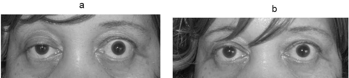 Myasthenia gravis ptosis
