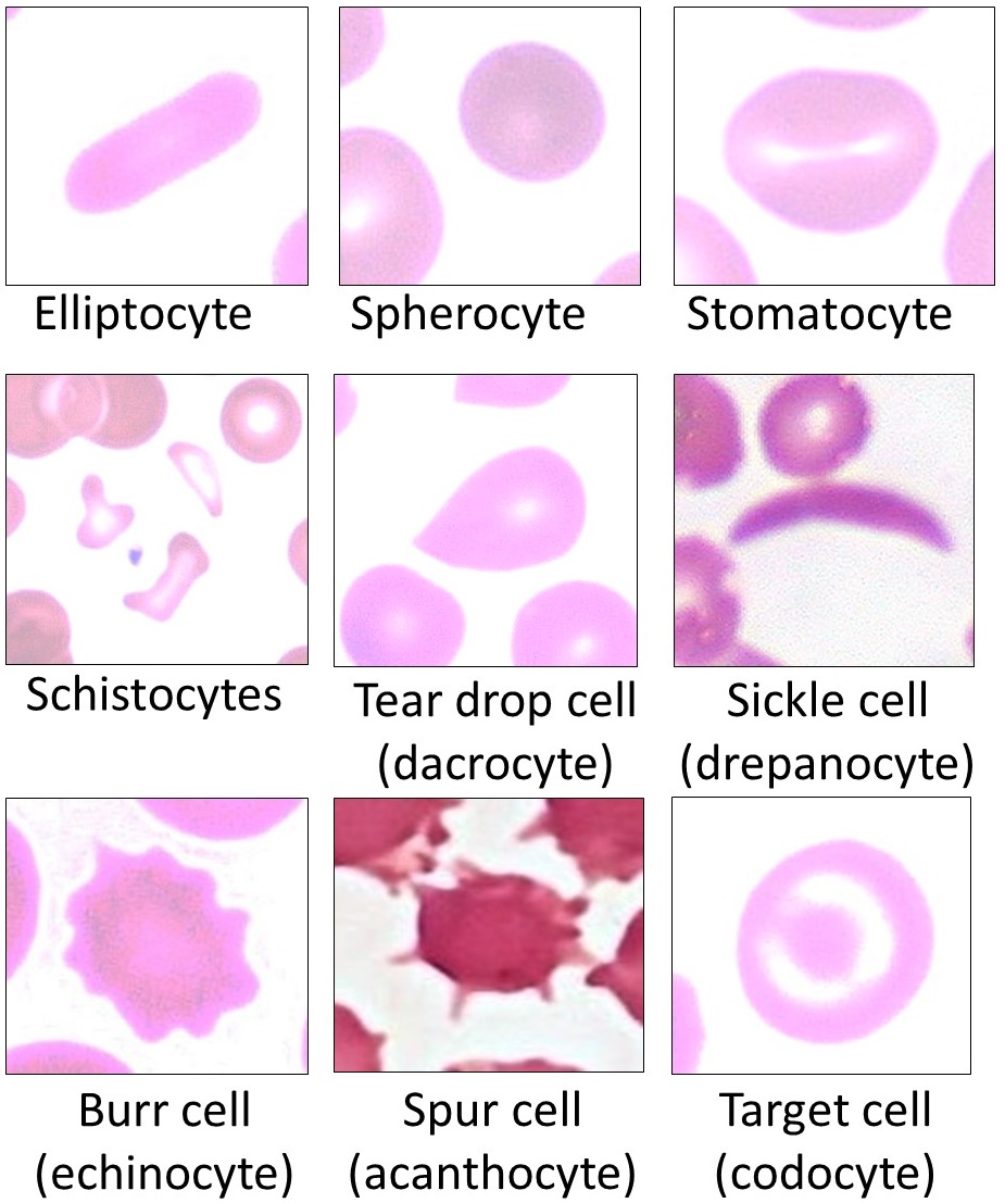 Red blood cell morphologies including target cells