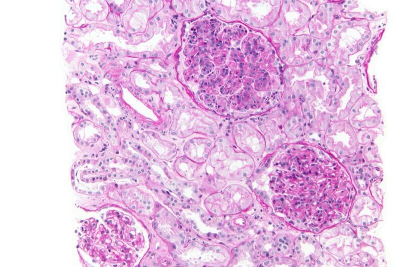 Post-infectious GN on PAS stain showing hypercellularity
