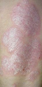 Psoriasis plaque lesions