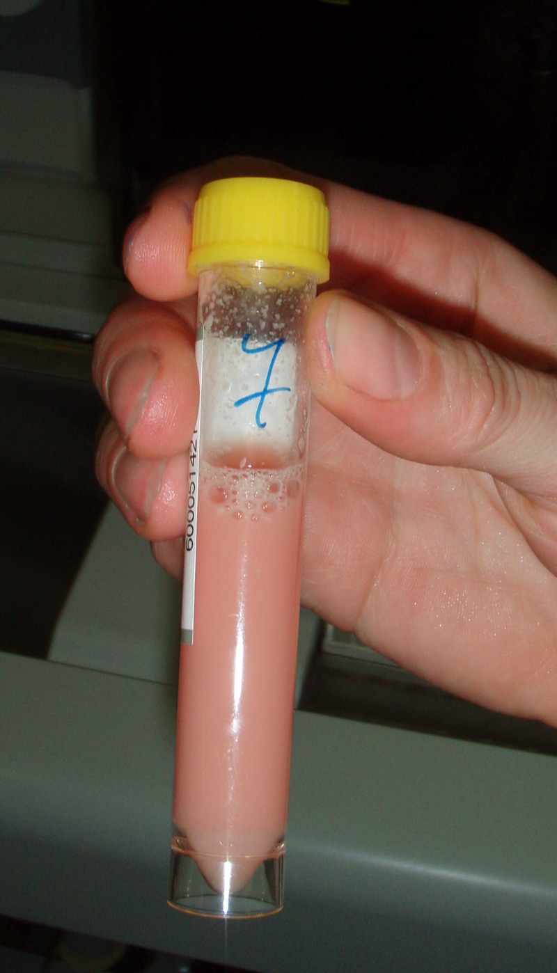 Purulent cerebrospinal fluid from bacterial meningitis