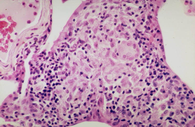 Non-caseating granuloma histology in sarcoidosis