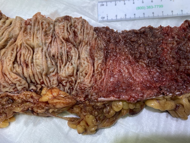 Severe ulcerative colitis endoscopy