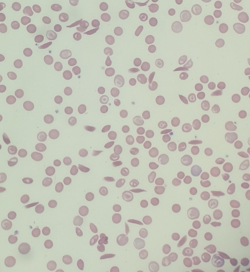Peripheral smear showing sickled red blood cells