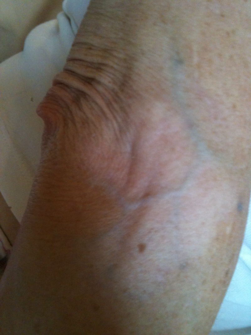 Vitiligo depigmentation on hand