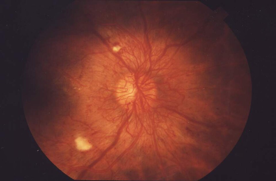 Fundus photograph showing proliferative diabetic retinopathy with abnormal new vessels