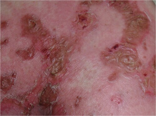 Necrolytic migratory erythema: pathognomonic rash of glucagonoma