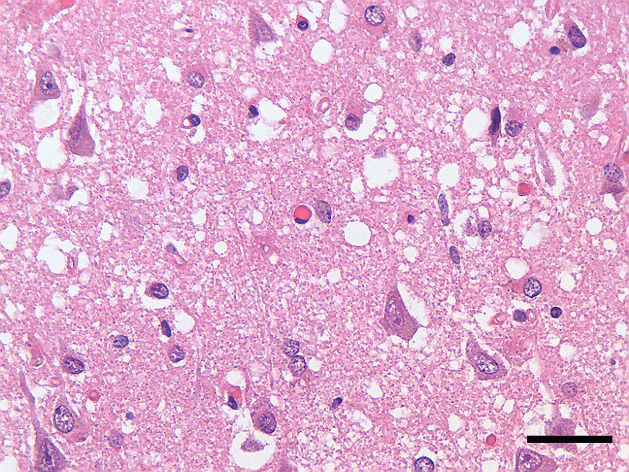 Spongiform vacuolar degeneration of the cortex in Creutzfeldt-Jakob disease