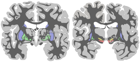 Coronal section of the human brain showing the deep gray nuclei