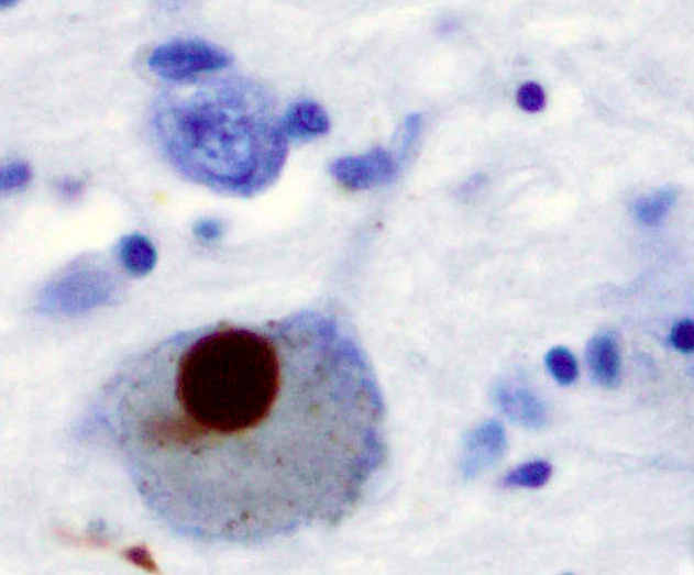 Lewy body histology, alpha-synuclein inclusion