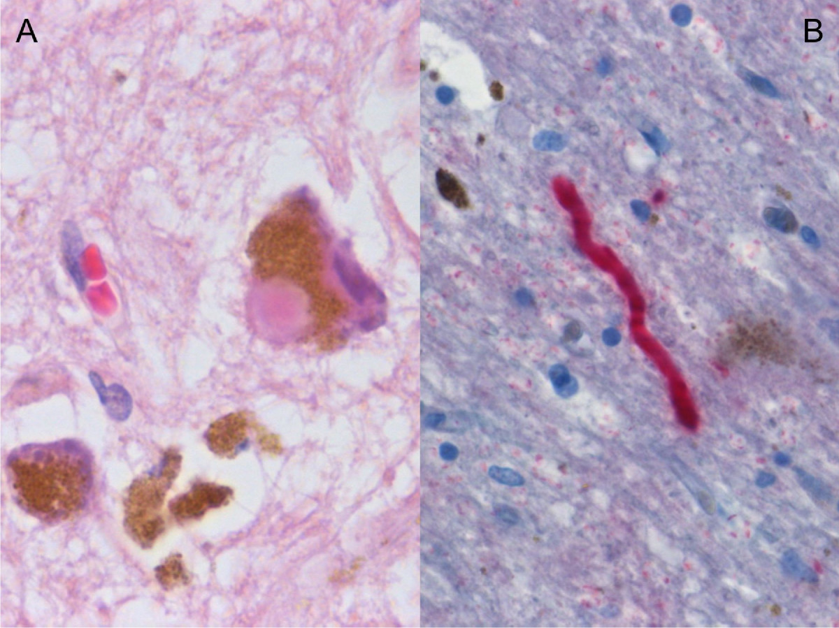 Substantia nigra histology in Parkinson disease with a Lewy body