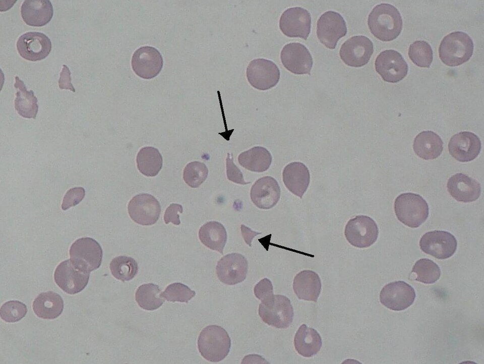 Schistocytes on peripheral blood smear