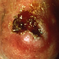Squamous cell carcinoma progression from AK